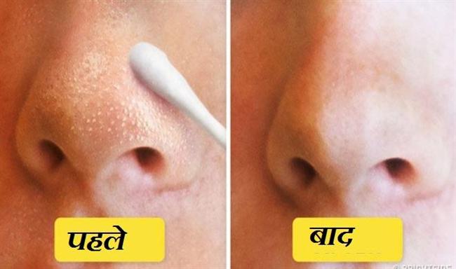  एक 5 मिनट का सिंपल उपाय और हमेशा के लिए पाएं ब्लैक हैड्स से निजात 
