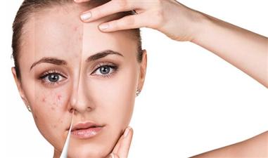  सिर्फ 30 सेकंड में ऐसे करें चेहरे के खुले पोर्स बंद