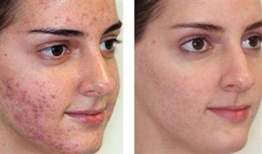 सिर्फ 3 दिनों में यूं पाएं चेहरे के डार्क स्पॉट से हमेशा के लिए निजात  