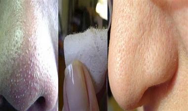सिर्फ 3 मिनट में इन 2 चीजों का इस्तेमाल कर पाएं ब्लैक हैड्स से निजात 