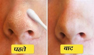  एक 5 मिनट का सिंपल उपाय और हमेशा के लिए पाएं ब्लैक हैड्स से निजात 